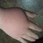 Yellow Jacket Sting - hand